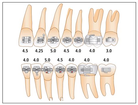 roth bracket positioning chart